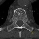 Hemangioma of vertebral body: CT - Computed tomography